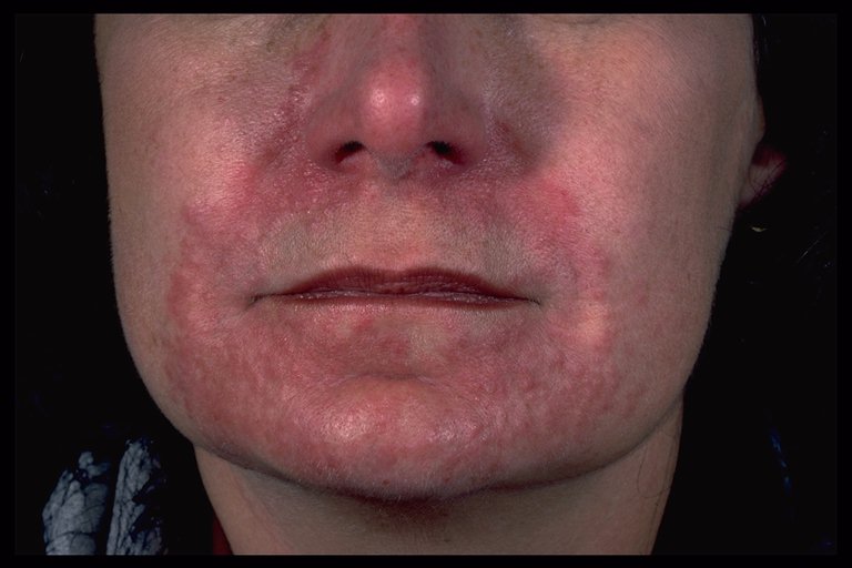steroid induced acne