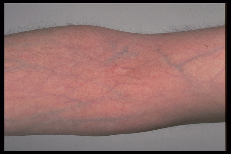 steroid atrophy