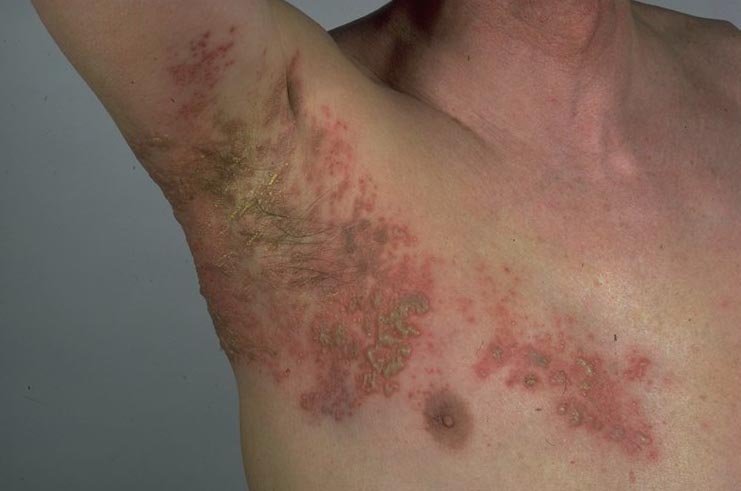 Armpit Rash - Diseases Pictures