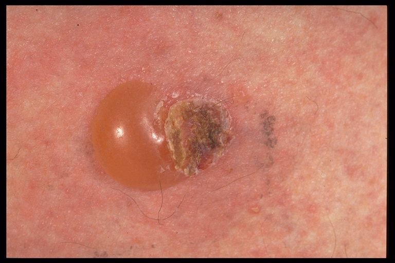 Hardin MD : Dermatology Pictures / Skin Disease Pictures