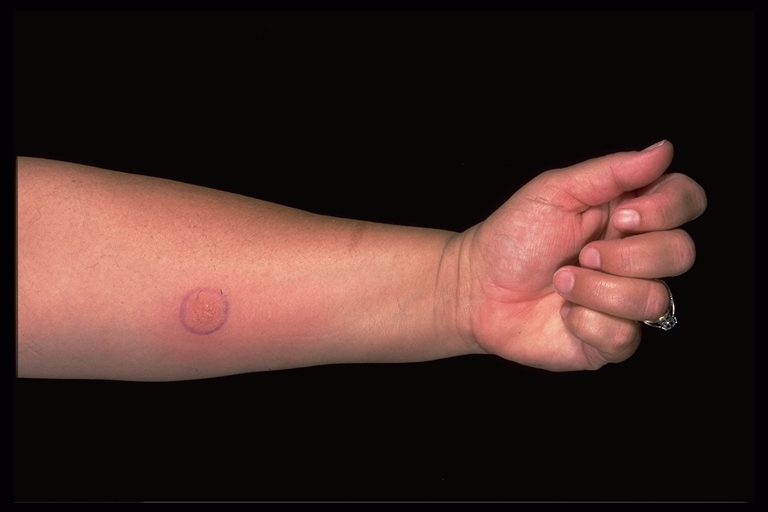 Cutaneous Melanoma - Medscape Reference