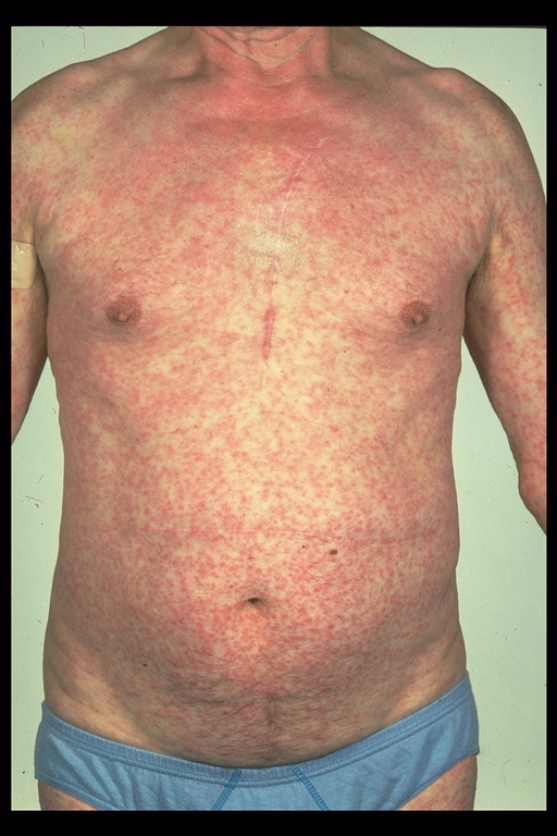 antibiotics rash