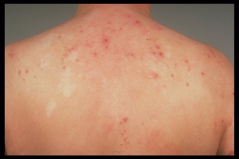 Adult Eczema - Information on Eczema