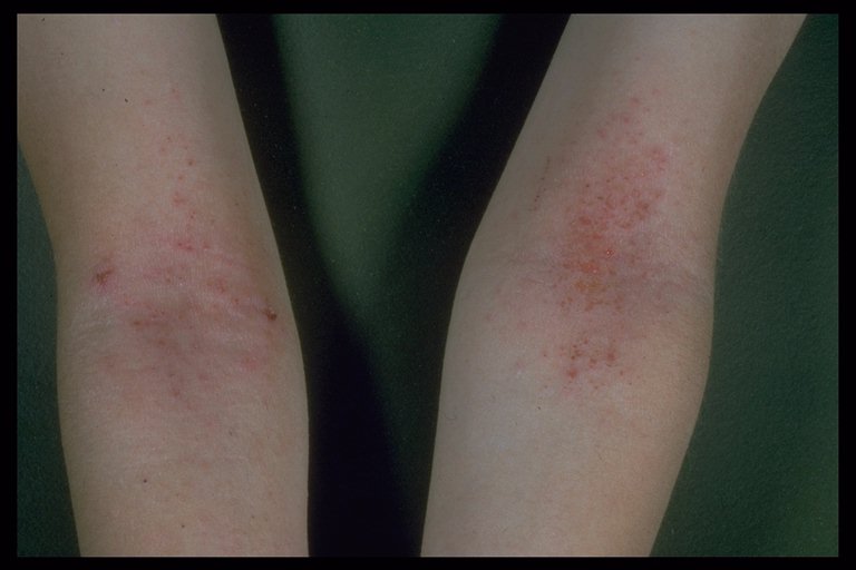 Eczema - KidsHealth