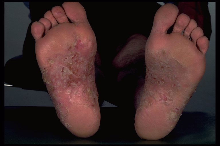 Eczema of the Foot - Foot Health Facts