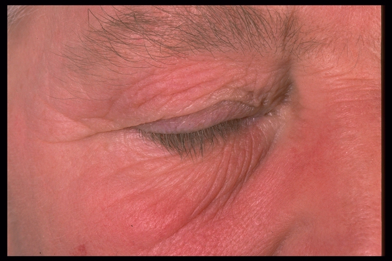 eyelid dermatitis
