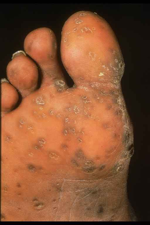 punctate keratoderma