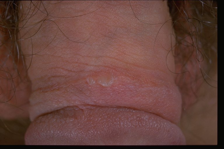 Syphilis Scab