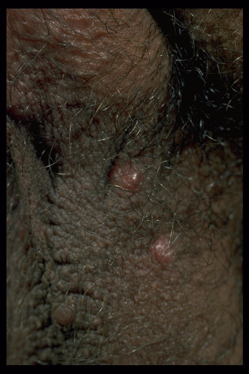 scabies on groin