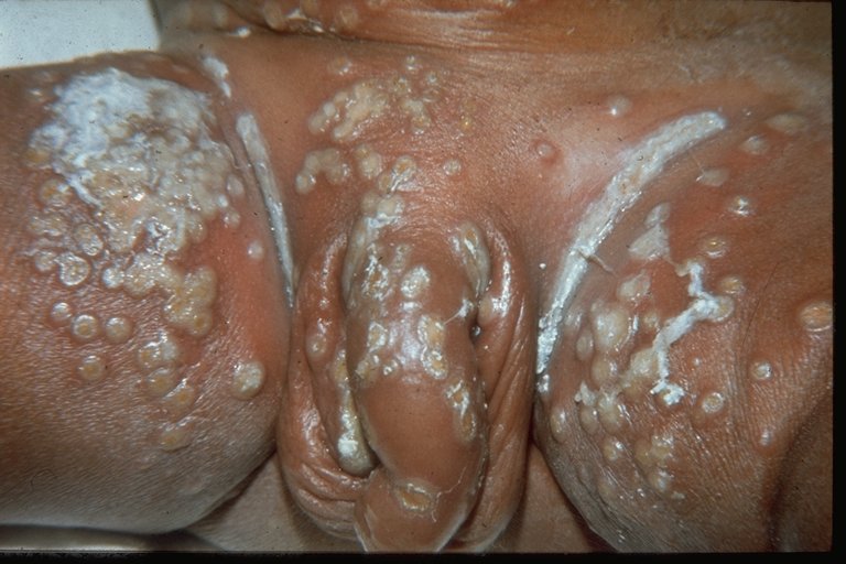 kaposi varicelliform eruption