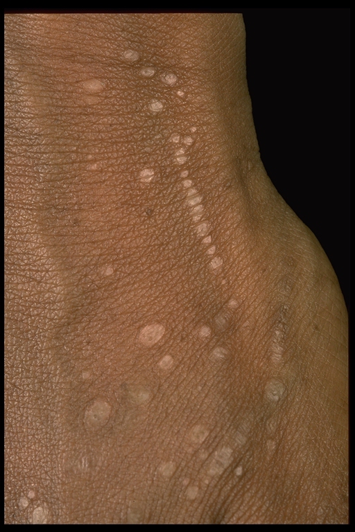 Lichen Nitidus Photo - Skin Disease Pictures