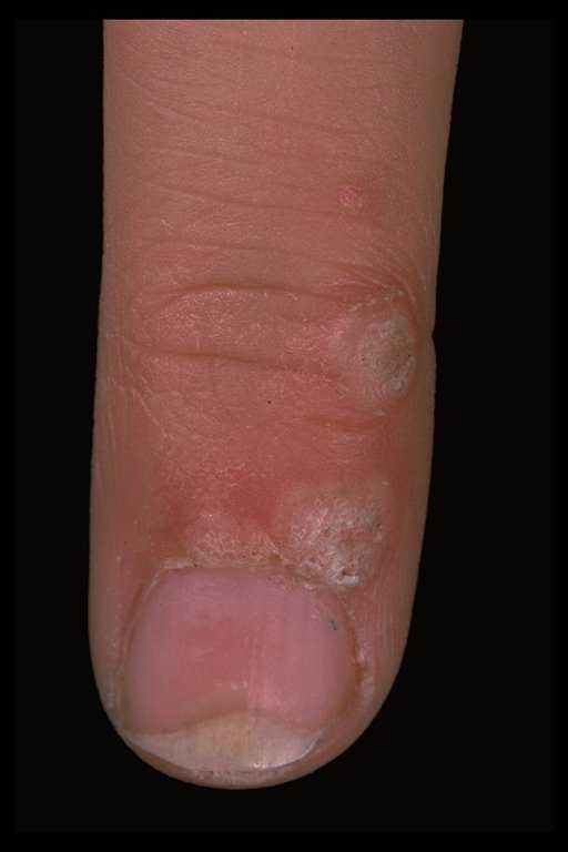 pictures of common warts