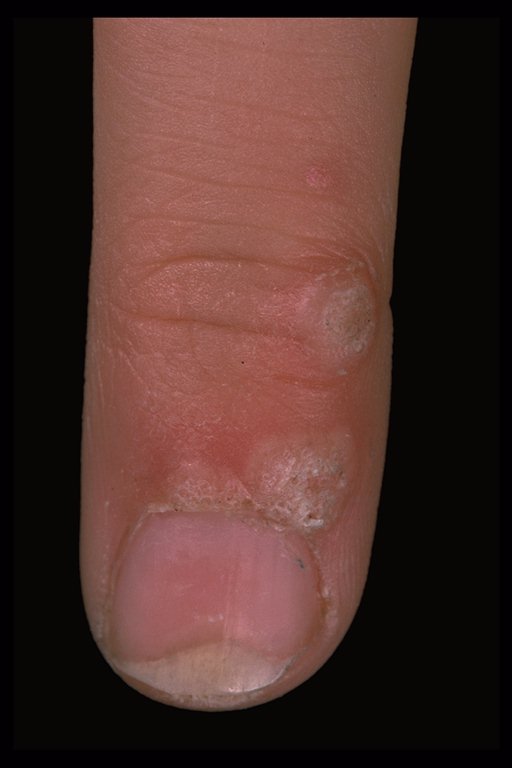 common warts