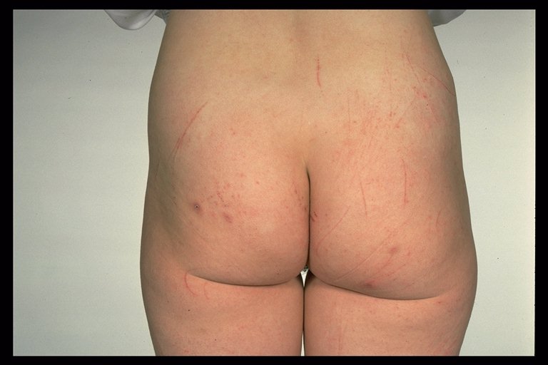 Beginning Of Scabies