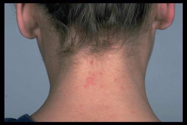 Pediculosis capitis - Wikipedia