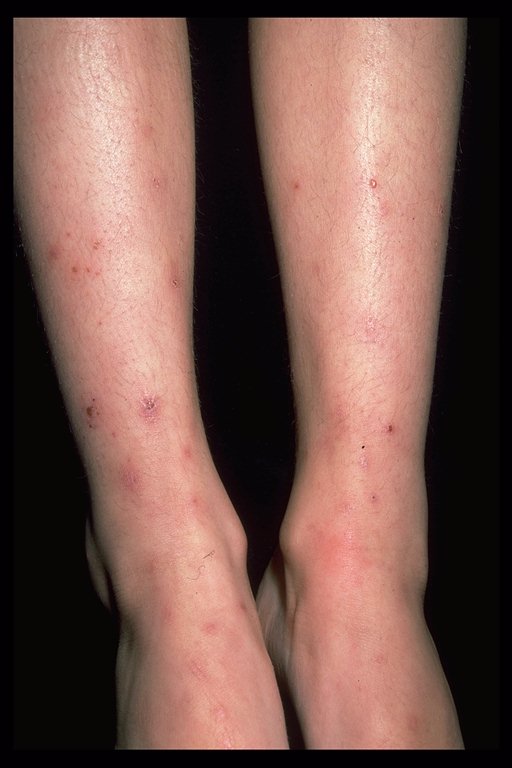 Hives Caused by Exercise | LIVESTRONG.COM