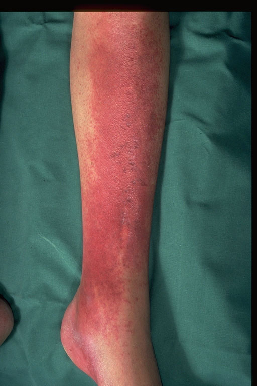 red rash on lower leg #9