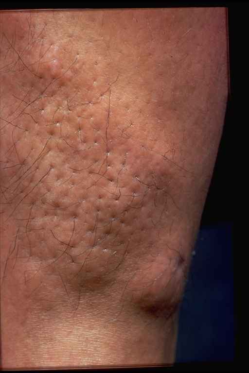 Pretibiaal myxoedeem (myxoedema) - huidziekten.nl