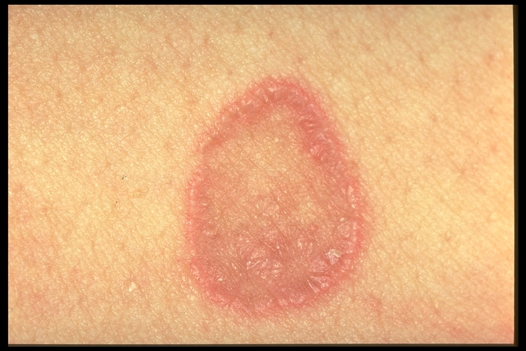 Annular lichen planus in association with Crohn disease ...