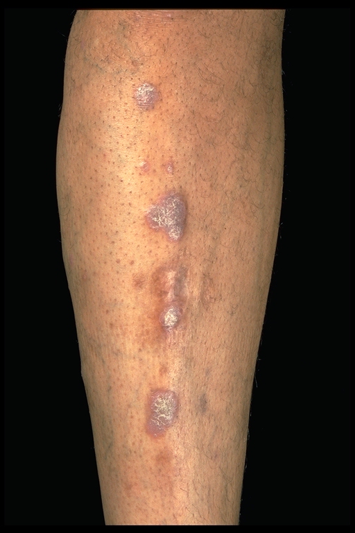 Diagnosis and Treatment of Lichen Planus - American Family ...