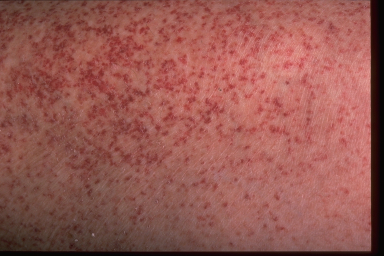 Red Spots on Skin - LoveToKnow