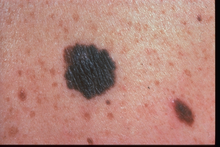 Lentigo maligna and lentigo maligna melanoma - DermNet NZ