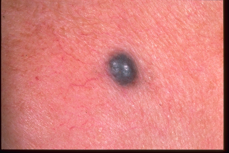 What Is Metastatic Melanoma Skin Cancer? - WebMD