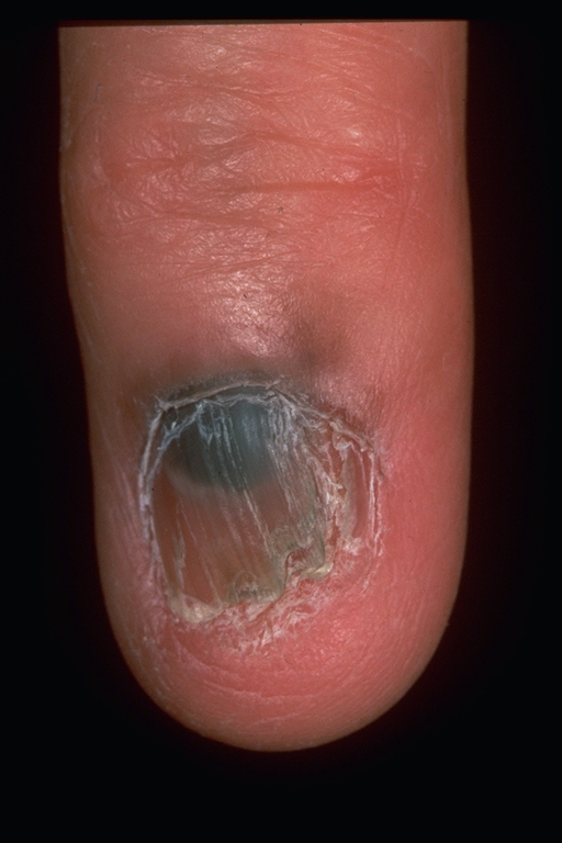 subungual melanoma picture