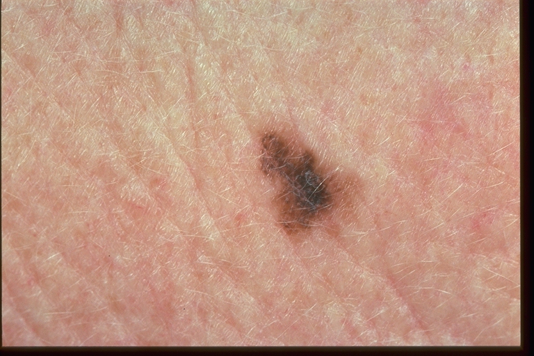 Melanoma Skin Cancer Identification Photo Gallery - Verywell