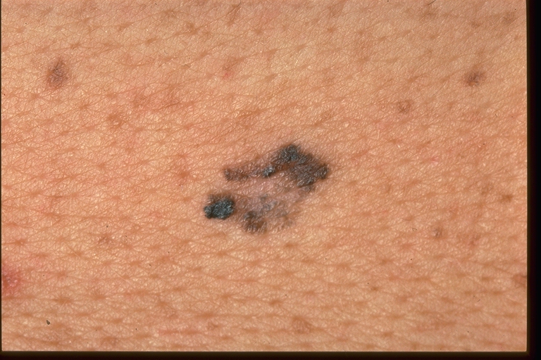 MELANOMA IN SITU - British Association of Dermatologists