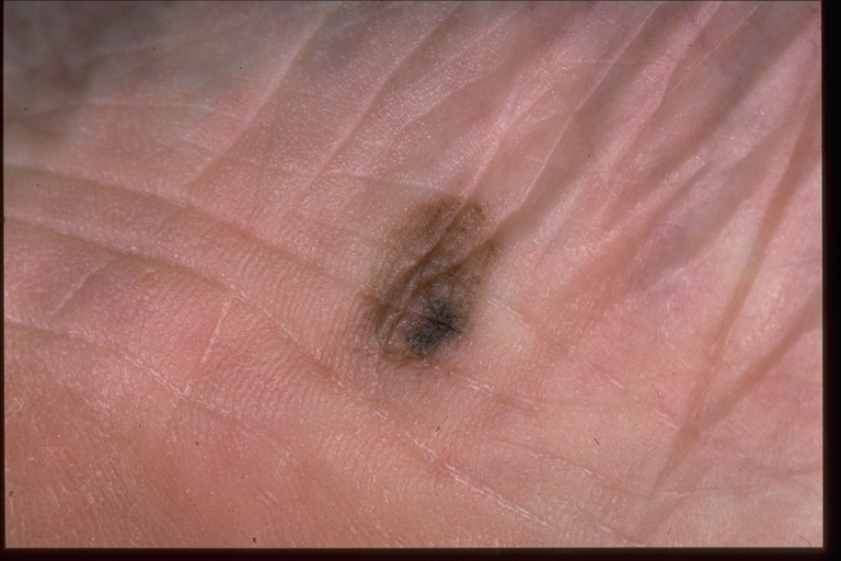 nodular melanoma pictures early #11