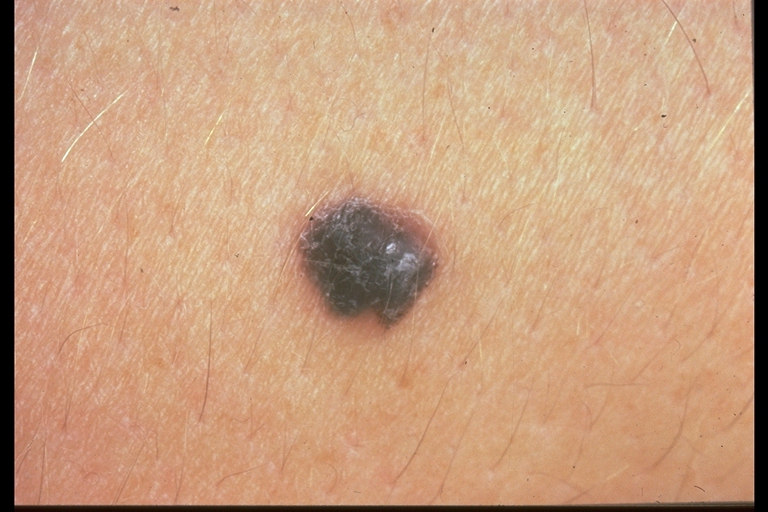 nodular melanomas #10