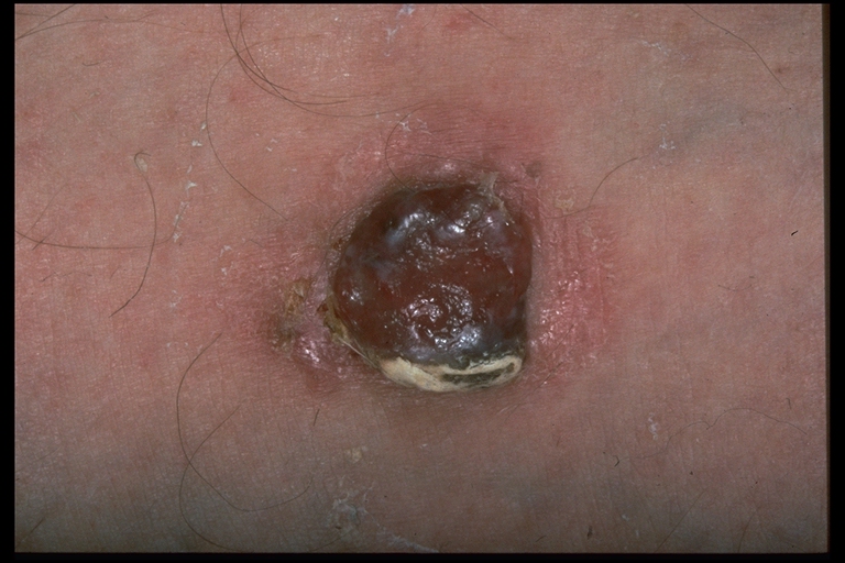 photos of melanomas