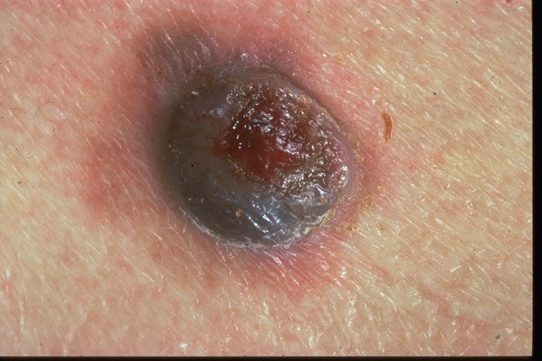 Nodular melanoma - Wikipedia