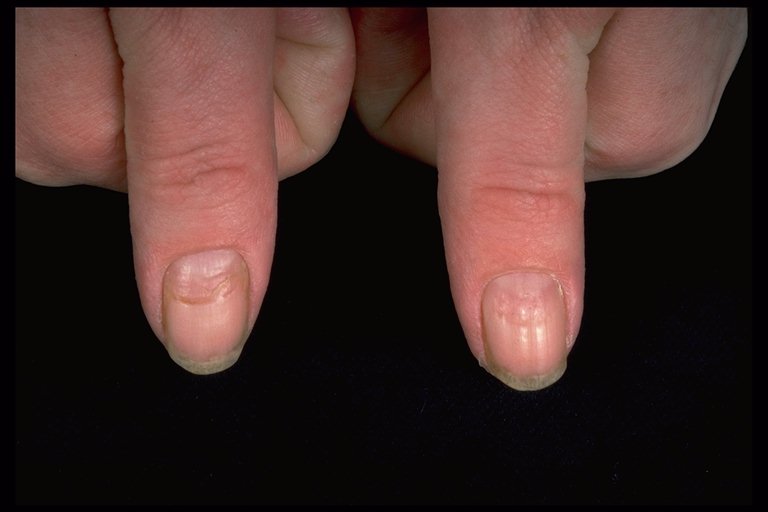 Nails Illness