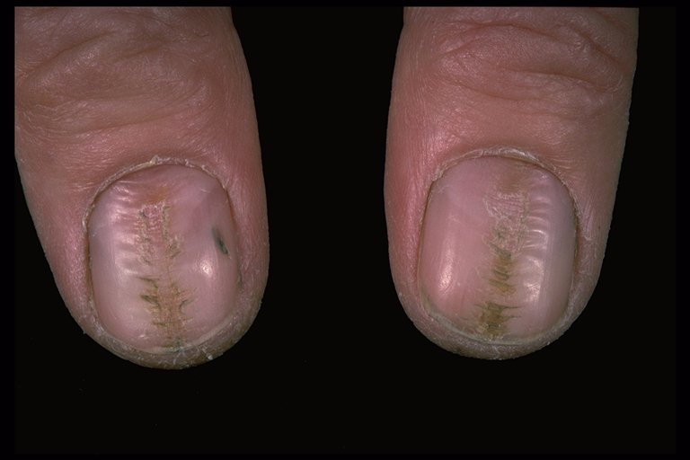 NAIL DISORDERS - Index of nail disorder in fingernails ...