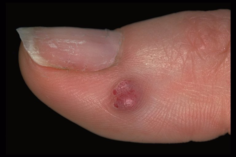 Pyogenic Granuloma Picture Image on MedicineNet.com