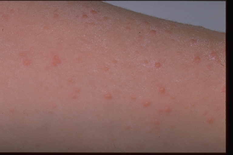 papular acrodermatitis of childhood