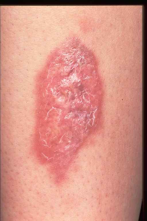 diabetic skin