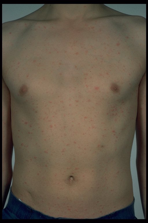 Pityriasis Rosea Symptoms, Treatments, Causes - WebMD