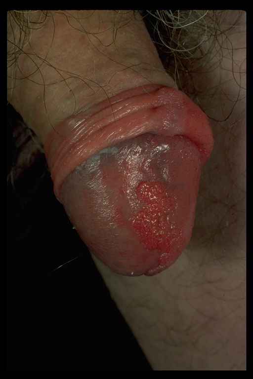 Raw Skin On Penis 109
