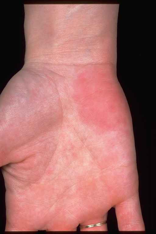 palmar erythema causes #11