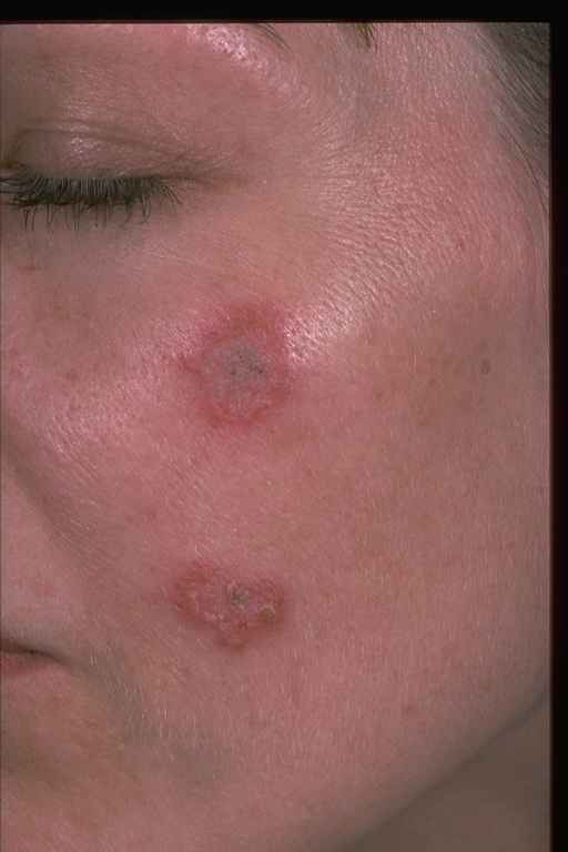 Early Diagnosis and Treatment of Discoid Lupus Erythematosus