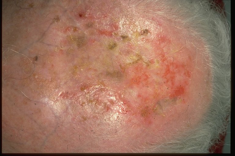 Pictures Of Ringworm, Information, Treatment