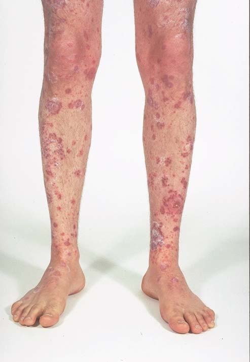 heat rash on legs pictures. walking in heat rash hives