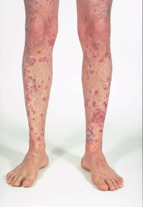 heat rash on legs pictures. heat rashes on legs. heat rash on legs pictures.