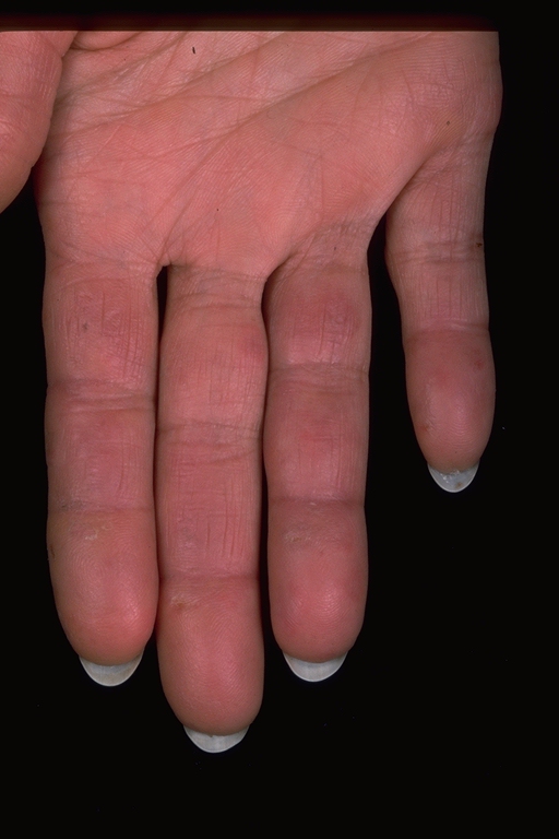 Chilblain Fingers
