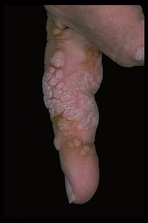 common warts on fingers. number of common warts are