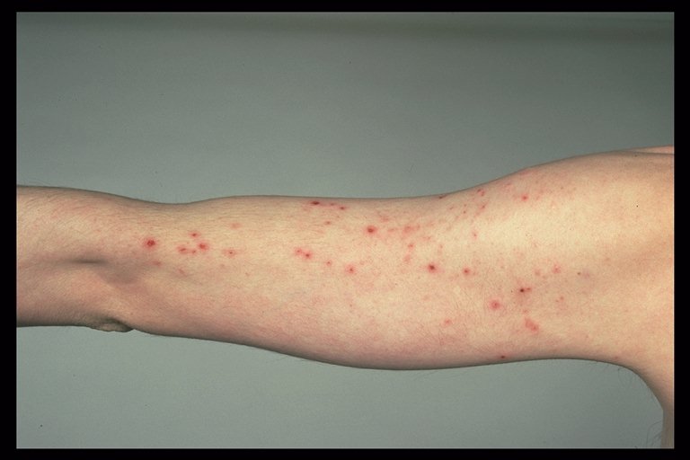 Aids Rash Picture