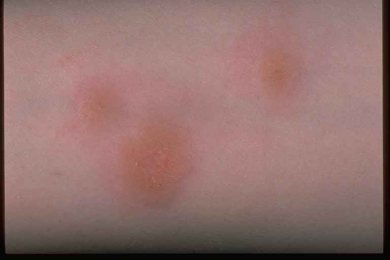 Necrobiosis Lipoidica Natural Treatment Necrobiosis Lipoidica Natural Treatment